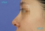 eye surgery