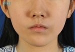 facial contouring