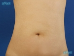 Liposuction