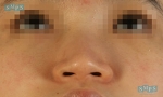 Rhinoplasty