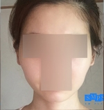 facial contouring