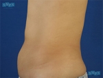 Liposuction