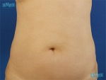 Liposuction