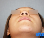 Rhinoplasty