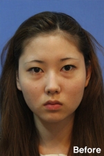 Izien Plastic Surgery,Reviews,Images, Promotions — Korea cost, reviews & before-after | MISOODA