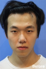 Izien Plastic Surgery,Reviews,Images, Promotions — Korea cost, reviews & before-after | MISOODA