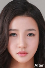 Izien Plastic Surgery,Reviews,Images, Promotions — Korea cost, reviews & before-after | MISOODA
