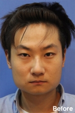 Izien Plastic Surgery,Reviews,Images, Promotions — Korea cost, reviews & before-after | MISOODA