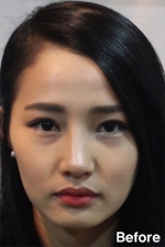 Izien Plastic Surgery,Reviews,Images, Promotions — Korea cost, reviews & before-after | MISOODA