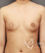 breast