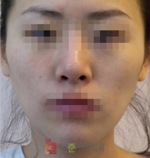 GangNam June Cosmetic Surgery Clinic,Reviews,Images, Promotions — Korea cost, reviews & before-after | MISOODA