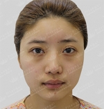 eye surgery