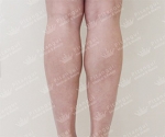 Liposuction
