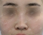 Rhinoplasty