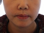 face lift