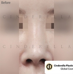 Cinderella Plastic Surgery,Reviews,Images,Promotions — Korea cost, reviews & before-after | MISOODA
