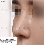 Cinderella Plastic Surgery,Reviews,Images,Promotions — Korea cost, reviews & before-after | MISOODA