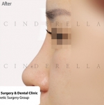 Cinderella Plastic Surgery,Reviews,Images,Promotions — Korea cost, reviews & before-after | MISOODA