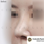 Cinderella Plastic Surgery,Reviews,Images,Promotions — Korea cost, reviews & before-after | MISOODA