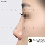 Cinderella Plastic Surgery,Reviews,Images,Promotions — Korea cost, reviews & before-after | MISOODA