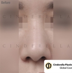 Cinderella Plastic Surgery,Reviews,Images,Promotions — Korea cost, reviews & before-after | MISOODA