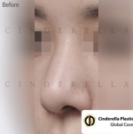 Cinderella Plastic Surgery,Reviews,Images,Promotions — Korea cost, reviews & before-after | MISOODA