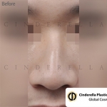 Cinderella Plastic Surgery,Reviews,Images,Promotions — Korea cost, reviews & before-after | MISOODA