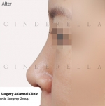 Cinderella Plastic Surgery,Reviews,Images,Promotions — Korea cost, reviews & before-after | MISOODA