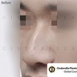 Cinderella Plastic Surgery,Reviews,Images,Promotions — Korea cost, reviews & before-after | MISOODA