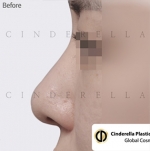 Cinderella Plastic Surgery,Reviews,Images,Promotions — Korea cost, reviews & before-after | MISOODA