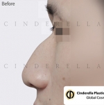 Cinderella Plastic Surgery,Reviews,Images,Promotions — Korea cost, reviews & before-after | MISOODA