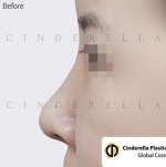 Cinderella Plastic Surgery,Reviews,Images,Promotions — Korea cost, reviews & before-after | MISOODA