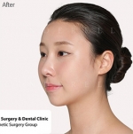 Cinderella Plastic Surgery,Reviews,Images,Promotions — Korea cost, reviews & before-after | MISOODA