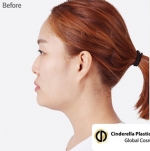 Cinderella Plastic Surgery,Reviews,Images,Promotions — Korea cost, reviews & before-after | MISOODA