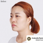 Cinderella Plastic Surgery,Reviews,Images,Promotions — Korea cost, reviews & before-after | MISOODA
