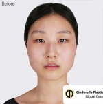 Cinderella Plastic Surgery,Reviews,Images,Promotions — Korea cost, reviews & before-after | MISOODA
