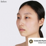 Cinderella Plastic Surgery,Reviews,Images,Promotions — Korea cost, reviews & before-after | MISOODA
