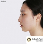 Cinderella Plastic Surgery,Reviews,Images,Promotions — Korea cost, reviews & before-after | MISOODA