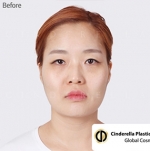 Cinderella Plastic Surgery,Reviews,Images,Promotions — Korea cost, reviews & before-after | MISOODA