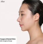 Cinderella Plastic Surgery,Reviews,Images,Promotions — Korea cost, reviews & before-after | MISOODA