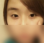 Hyundai Aesthetics, Reviews, Images, Promotions — Korea cost, reviews & before-after | MISOODA