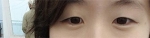 Hyundai Aesthetics, Reviews, Images, Promotions — Korea cost, reviews & before-after | MISOODA
