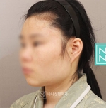 facial bone