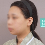 facial bone
