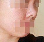 Hyundai Aesthetics, Reviews, Images, Promotions — Korea cost, reviews & before-after | MISOODA