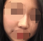 Hyundai Aesthetics, Reviews, Images, Promotions — Korea cost, reviews & before-after | MISOODA