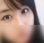Hyundai Aesthetics, Reviews, Images, Promotions — Korea cost, reviews & before-after | MISOODA