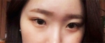 Hyundai Aesthetics, Reviews, Images, Promotions — Korea cost, reviews & before-after | MISOODA
