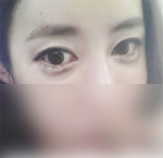 Hyundai Aesthetics, Reviews, Images, Promotions — Korea cost, reviews & before-after | MISOODA