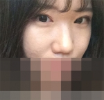 Hyundai Aesthetics, Reviews, Images, Promotions — Korea cost, reviews & before-after | MISOODA